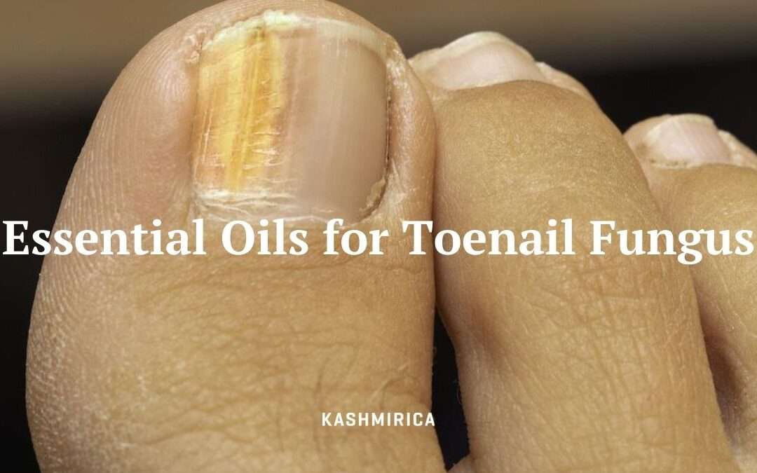 What are the 4 Best Essential Oils for Toenail Fungus?